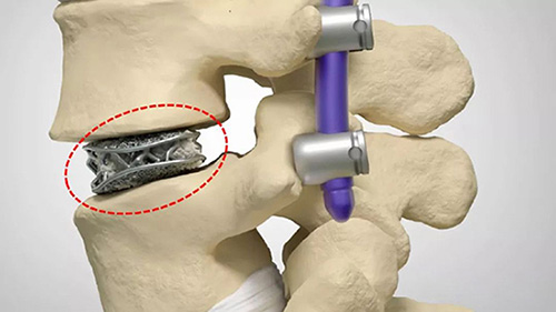 3D打印技术在骨科的实际应用有哪些？(图3)